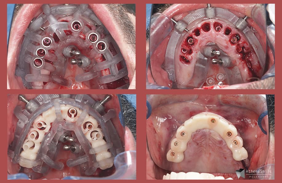 Rehabilitation of maxillary FP1 with advanced periodontitis, non